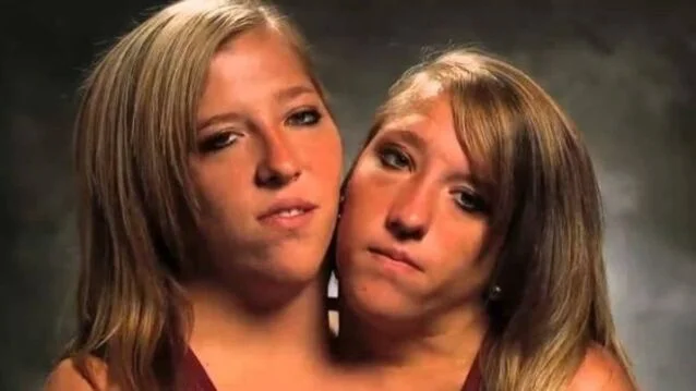 les sœurs siamoises abigail et brittany enceinte - Les Sœurs Siamoises Abigail Et Brittany Enceinte - Médias Célèbres