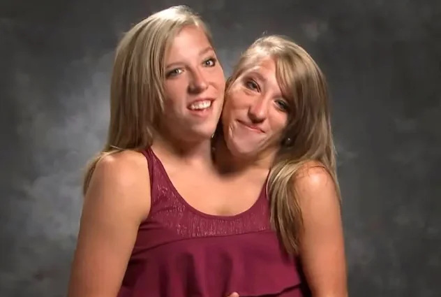 les sœurs siamoises abigail et brittany enceinte - Abby et Brittany Enceinte: "Abby et Brittany Hensel: État de Grossesse ...